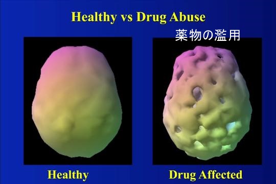 薬物を濫用した脳のSPECT画像